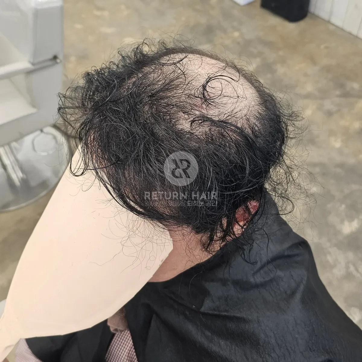 탈모 치트펌 파마 시술 전 사진