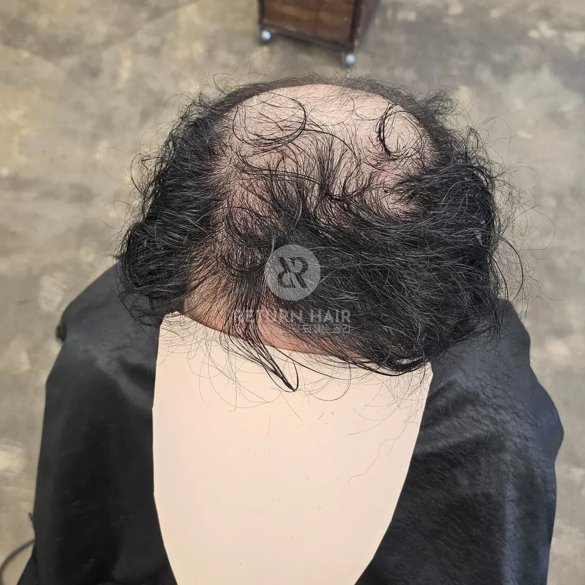 탈모 치트펌 파마 시술 전 사진 2