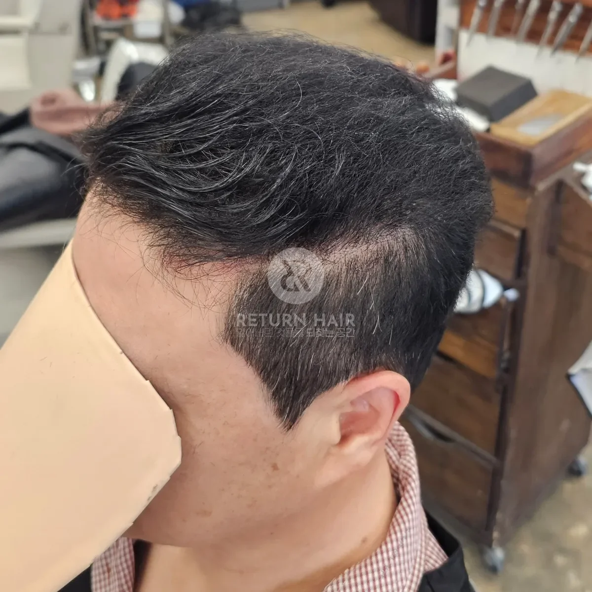 탈모 치트펌 파마 시술 후 결과 사진