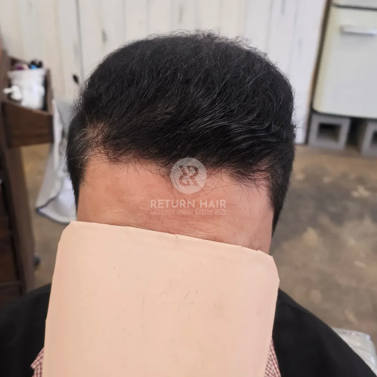 탈모 치트펌 파마 시술 후 결과 사진 2