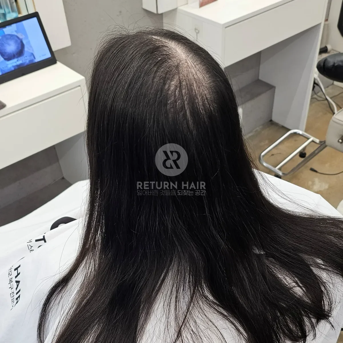 입춘 테라피 (플라즈마 PDRN) 시술 전 사진 2