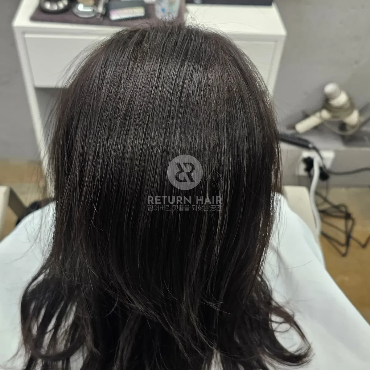 입춘 테라피 (플라즈마 PDRN) 시술 후 결과 사진 1