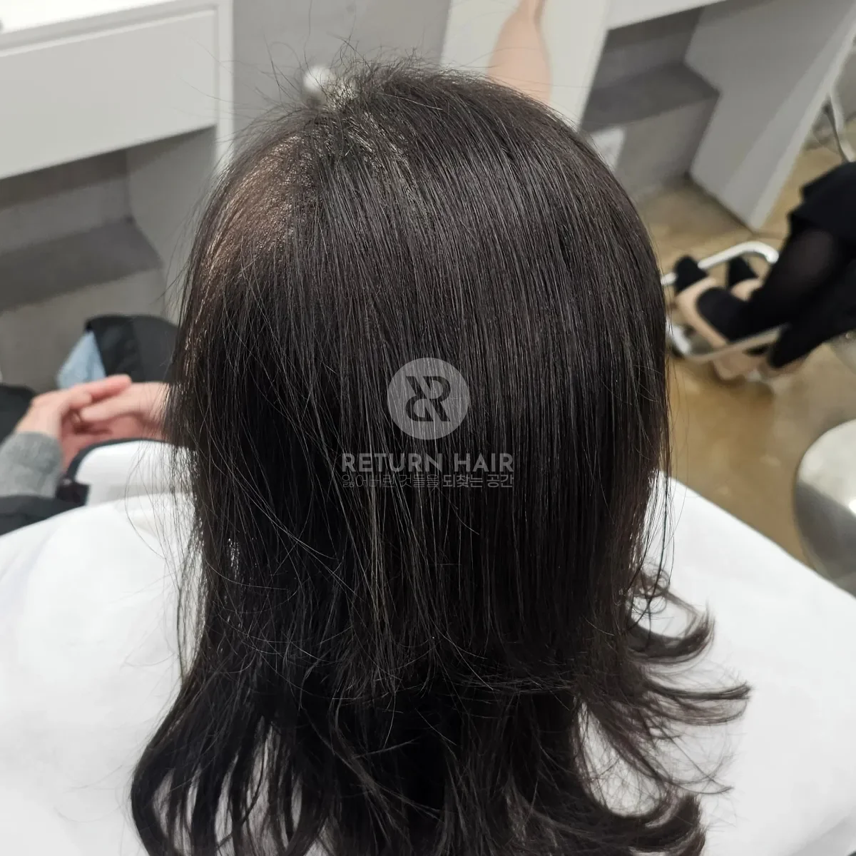 입춘 테라피 (플라즈마 PDRN) 시술 후 결과 사진 2