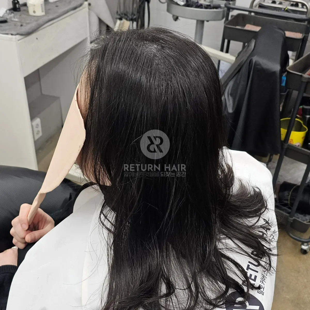 입춘 테라피 (플라즈마 PDRN) 시술 후 결과 사진 3