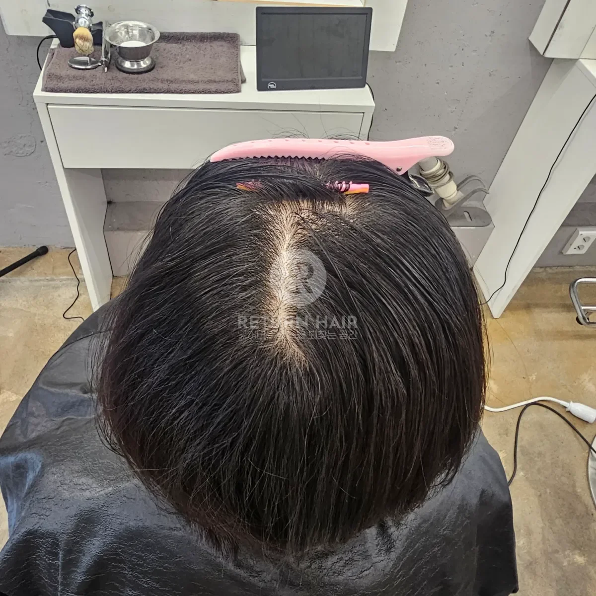 회춘펌 (뿌리볼륨 교정펌) 시술 전 사진 2