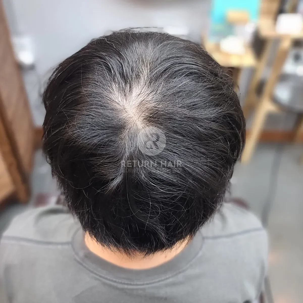 탈모 치트펌 파마 시술 전 사진