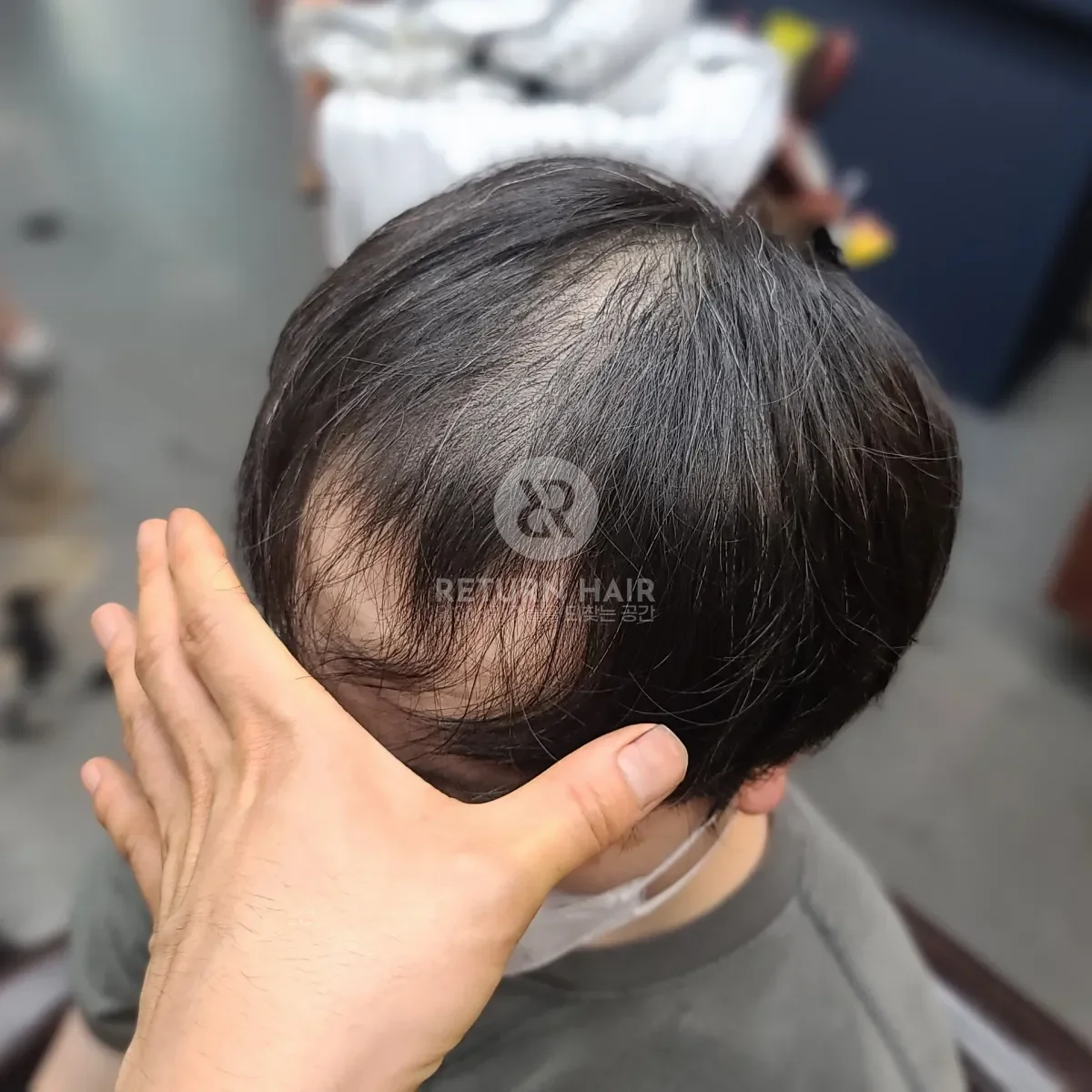 탈모 치트펌 파마 시술 전 사진 2
