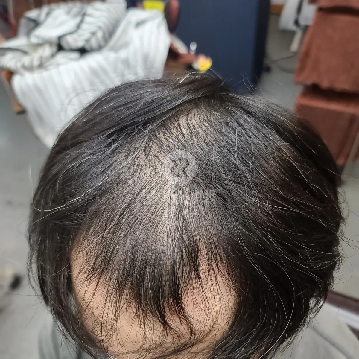 탈모 치트펌 파마 시술 전 사진 3