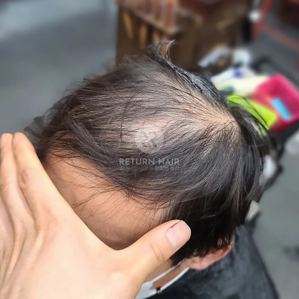 탈모 치트펌 파마 시술 전 사진 4