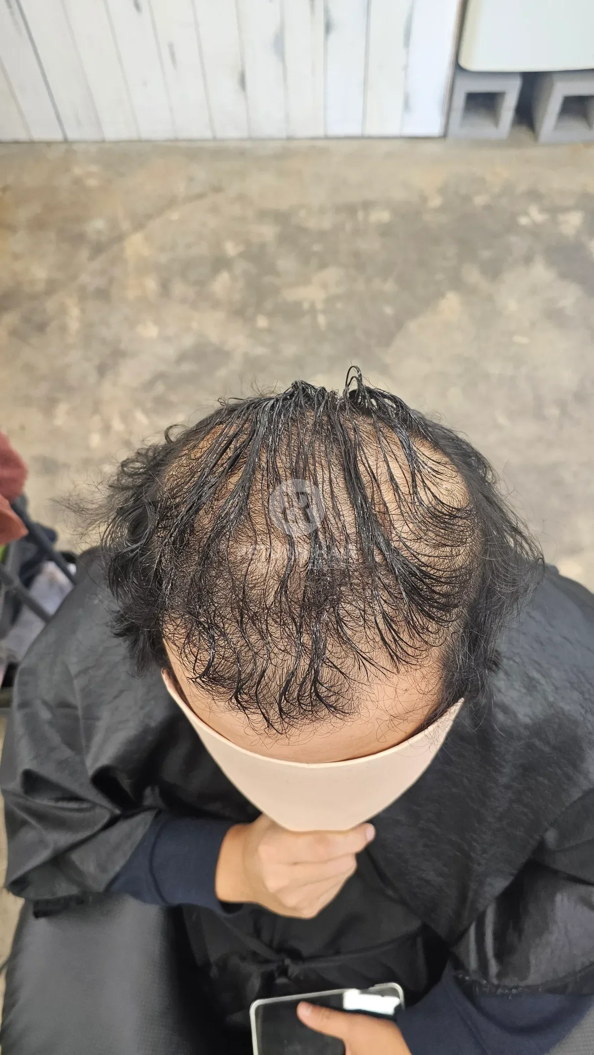 탈모 치트펌 파마 시술 전 사진