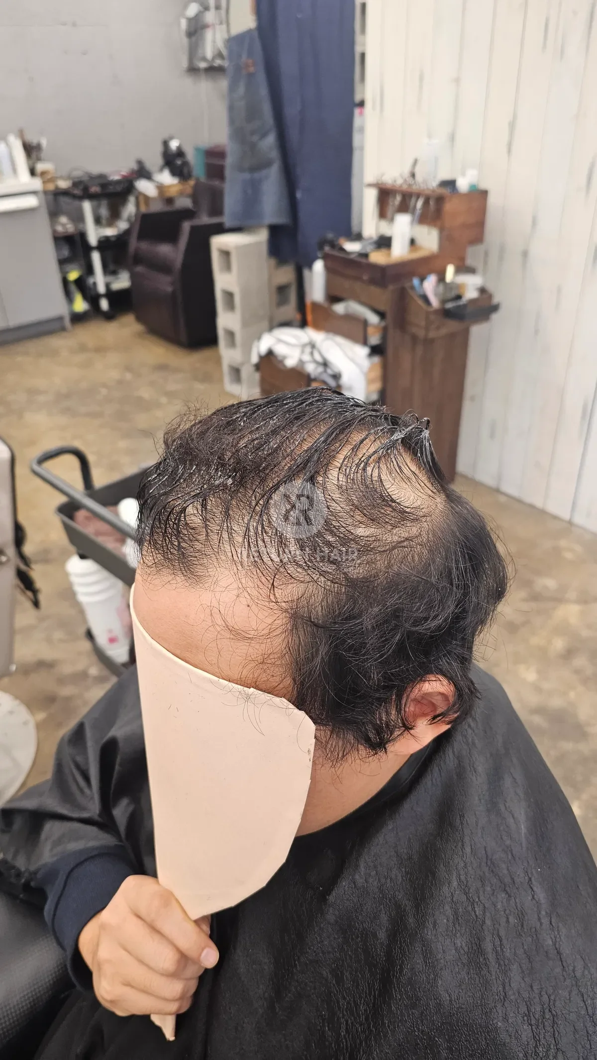 탈모 치트펌 파마 시술 전 사진 2
