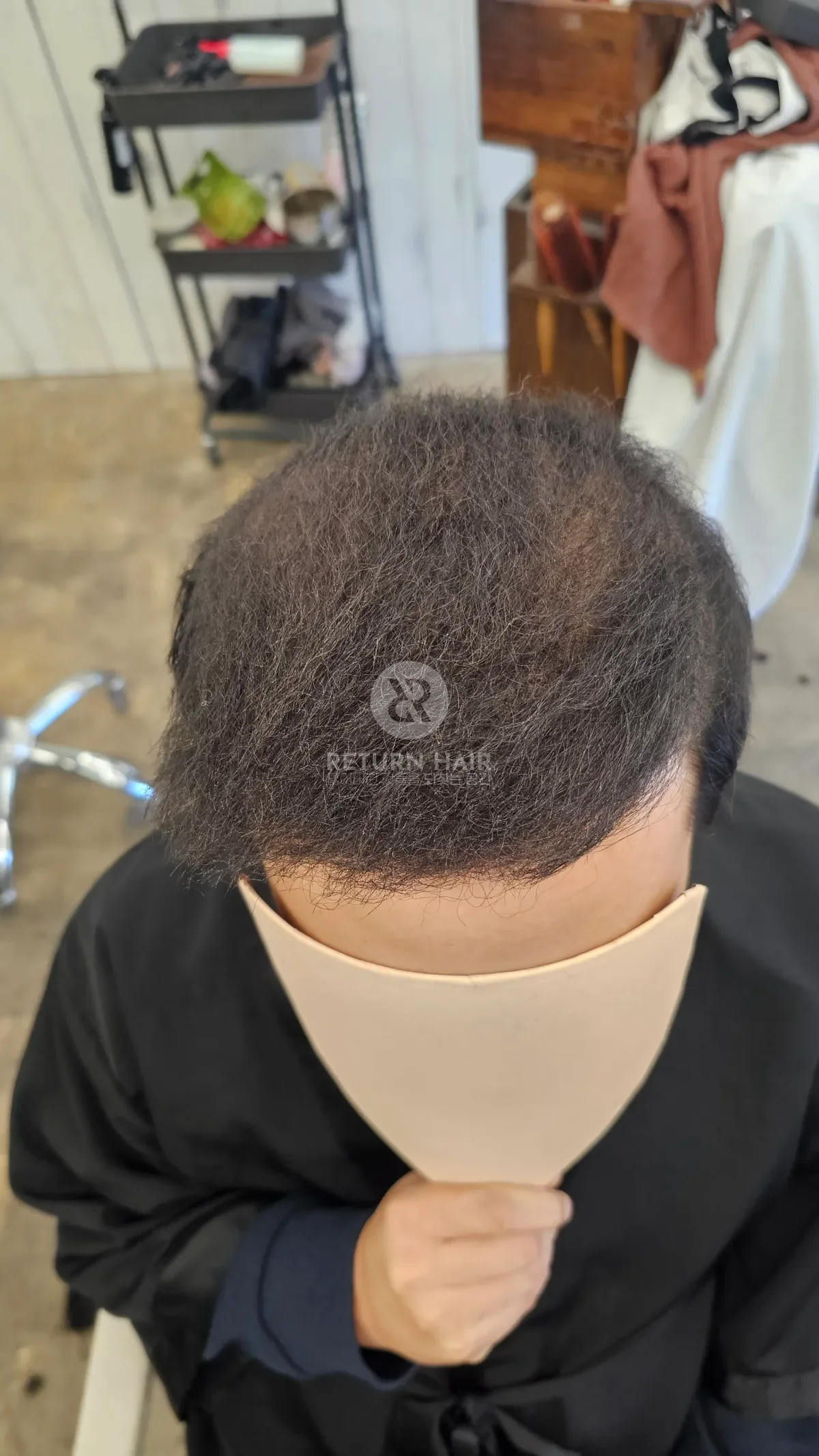 탈모 치트펌 파마 시술 후 결과 사진