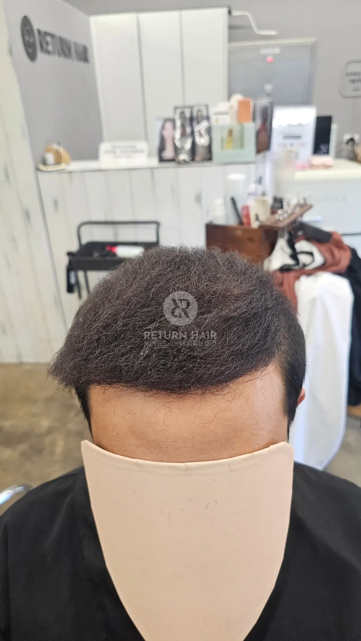탈모 치트펌 파마 시술 후 결과 사진 2