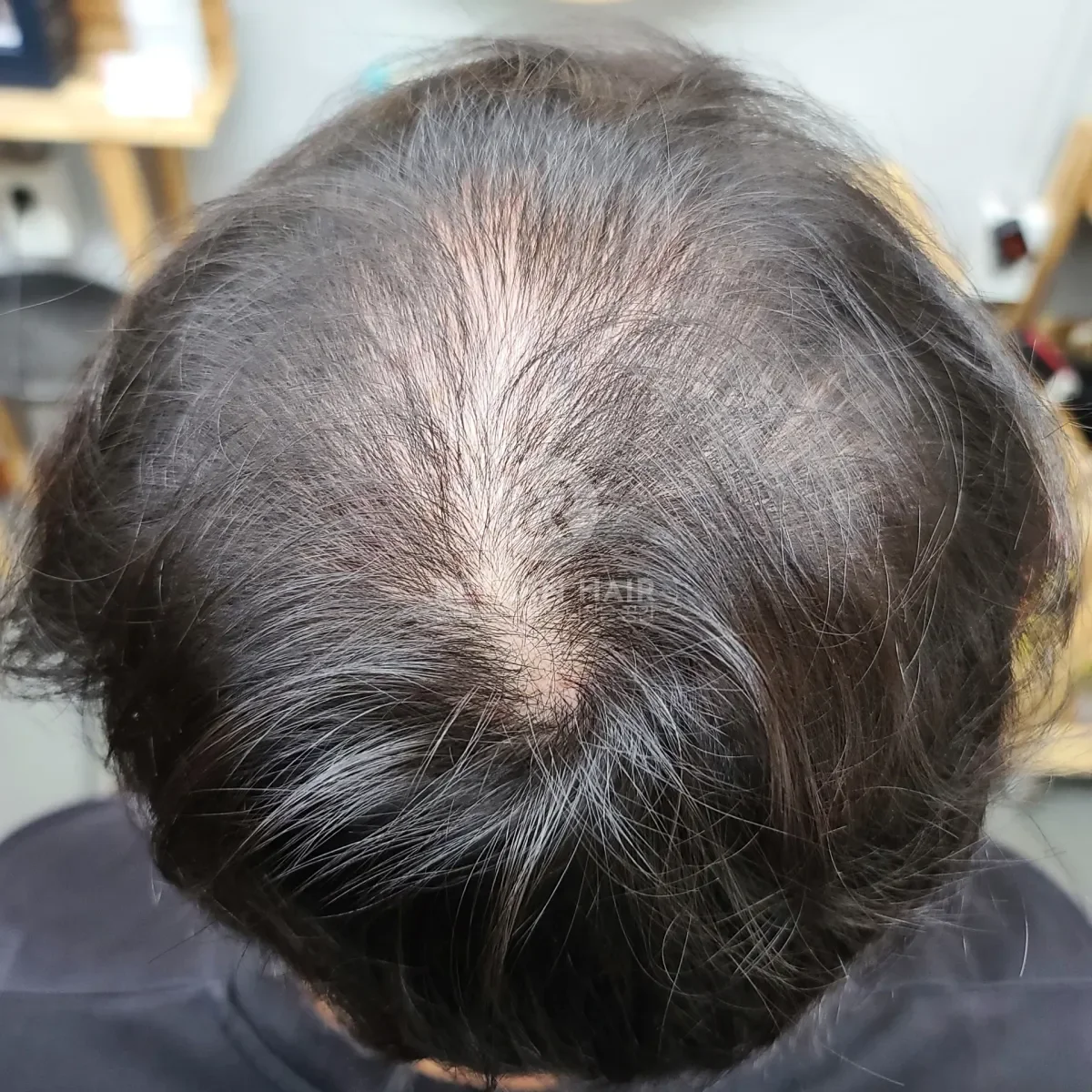 탈모 치트펌 파마 시술 전 사진