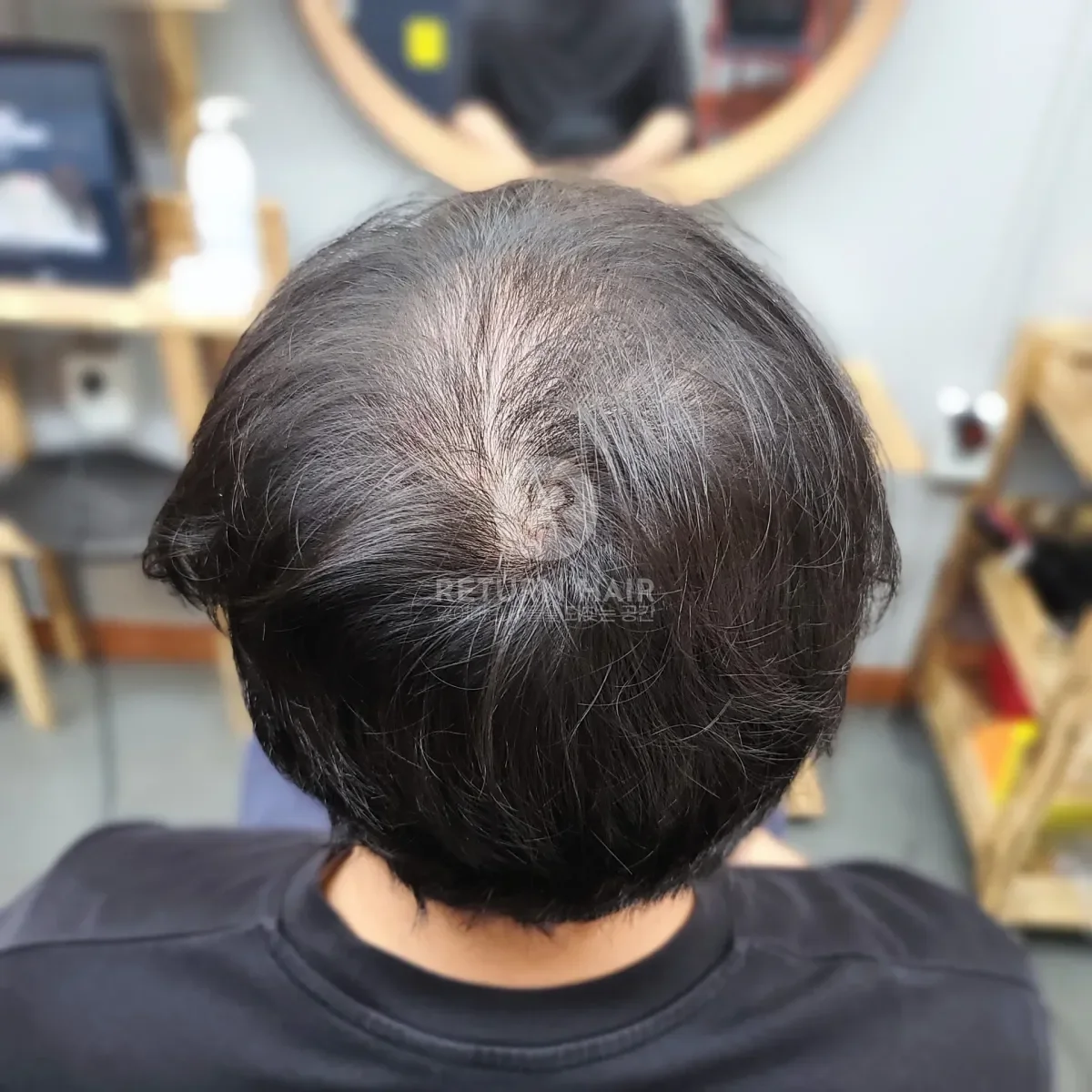탈모 치트펌 파마 시술 전 사진