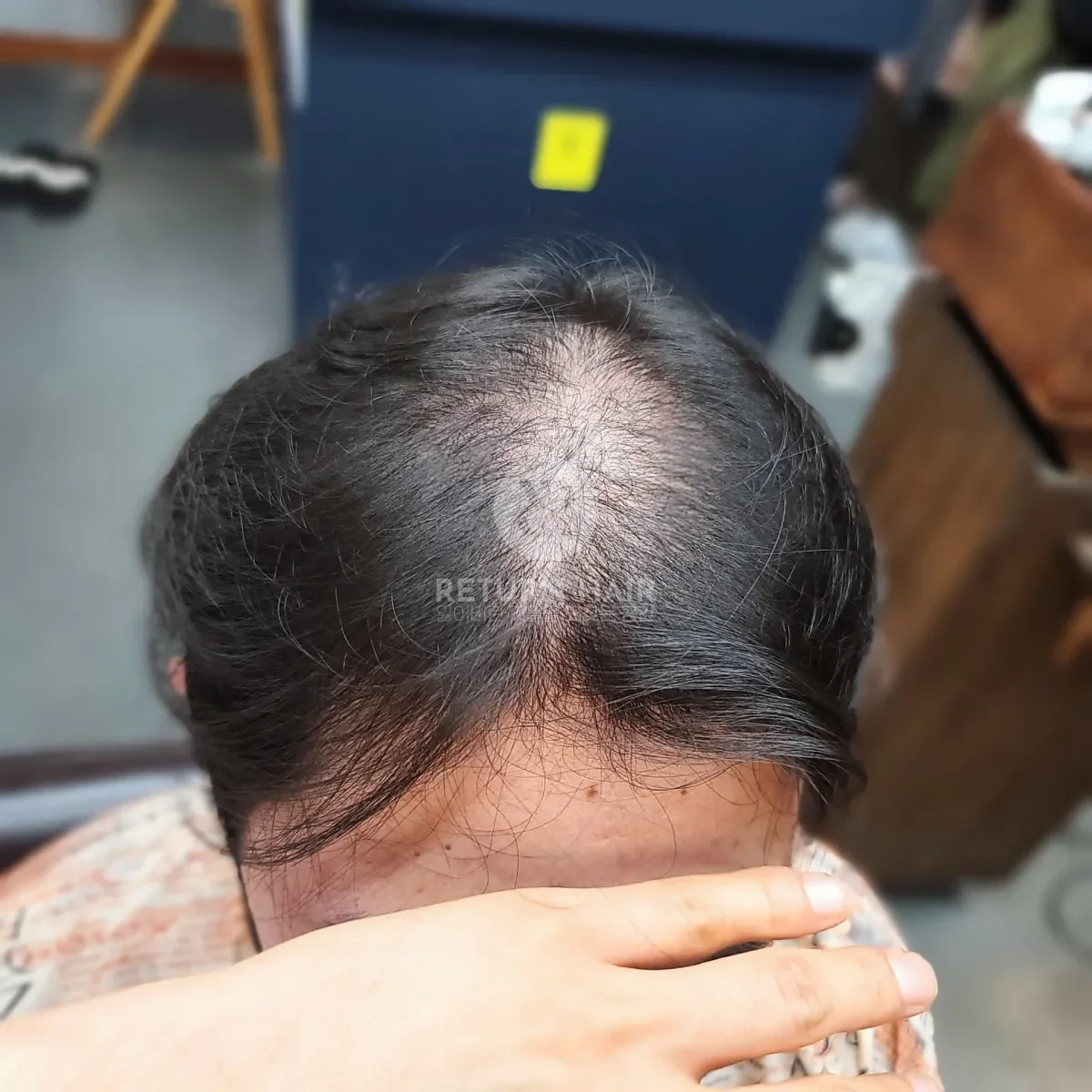 탈모 치트펌 파마 시술 전 사진 2
