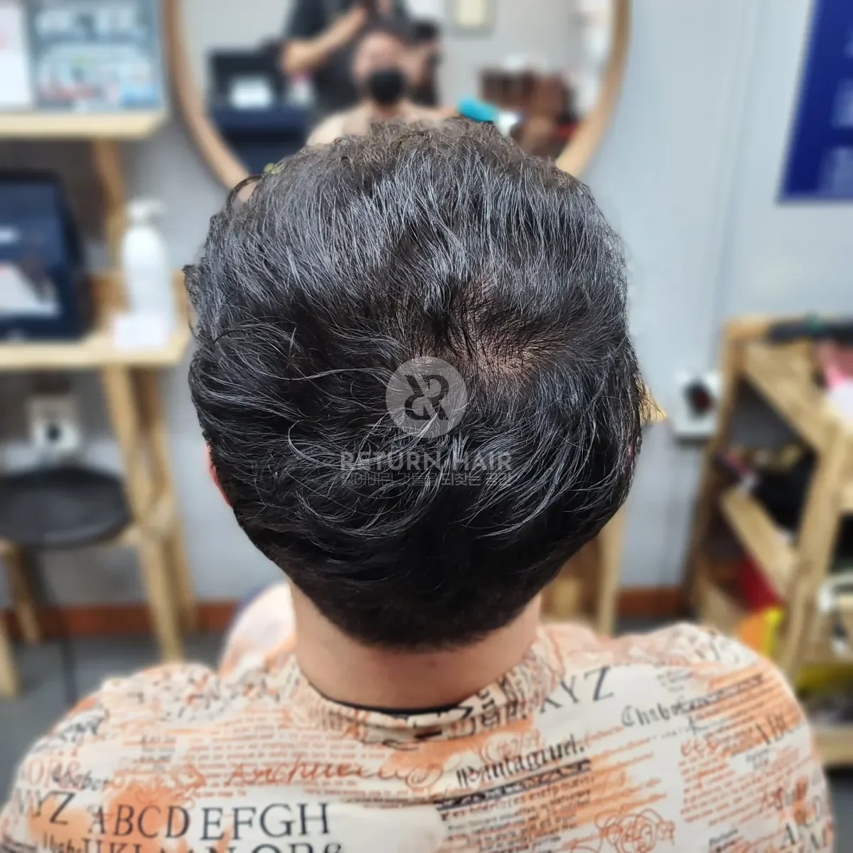 탈모 치트펌 파마 시술 후 결과 사진 2