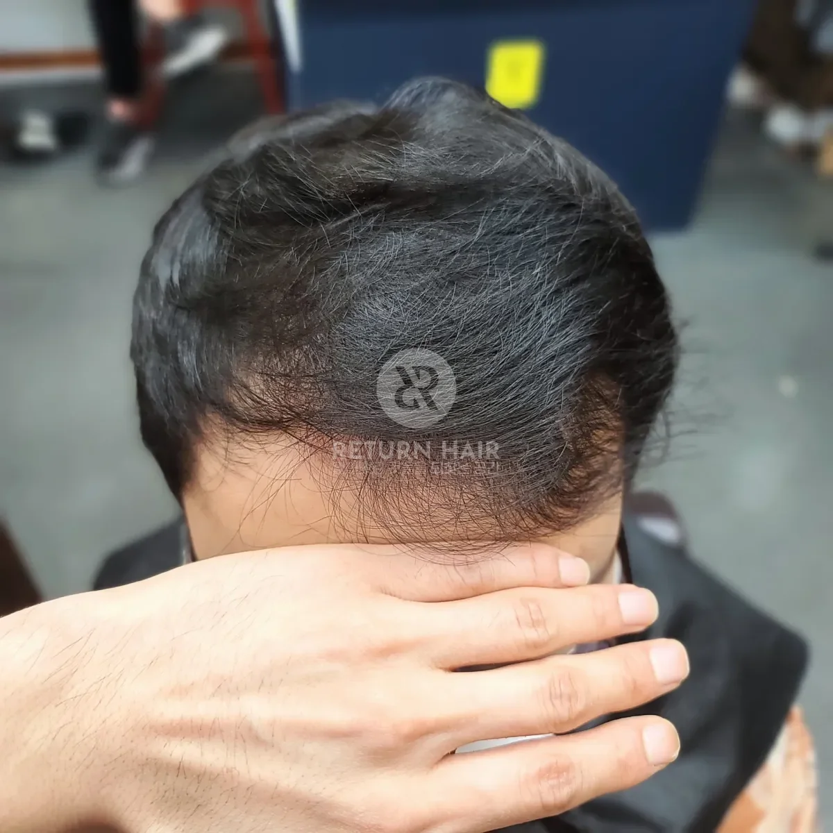 탈모 치트펌 파마 시술 전 사진 2