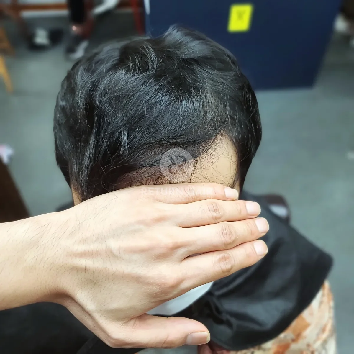 탈모 치트펌 파마 시술 전 사진 3