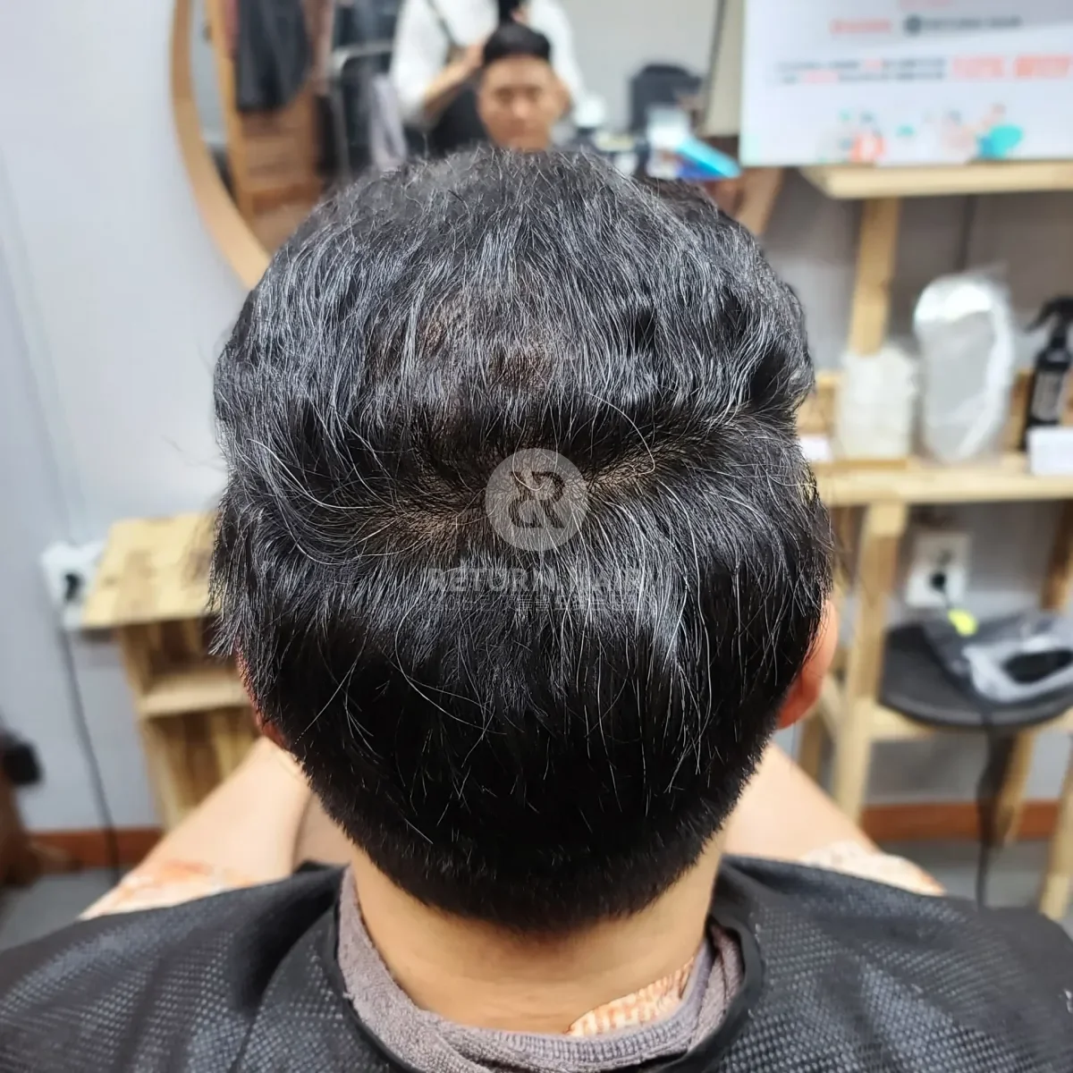 탈모 치트펌 파마 시술 후 결과 사진 2