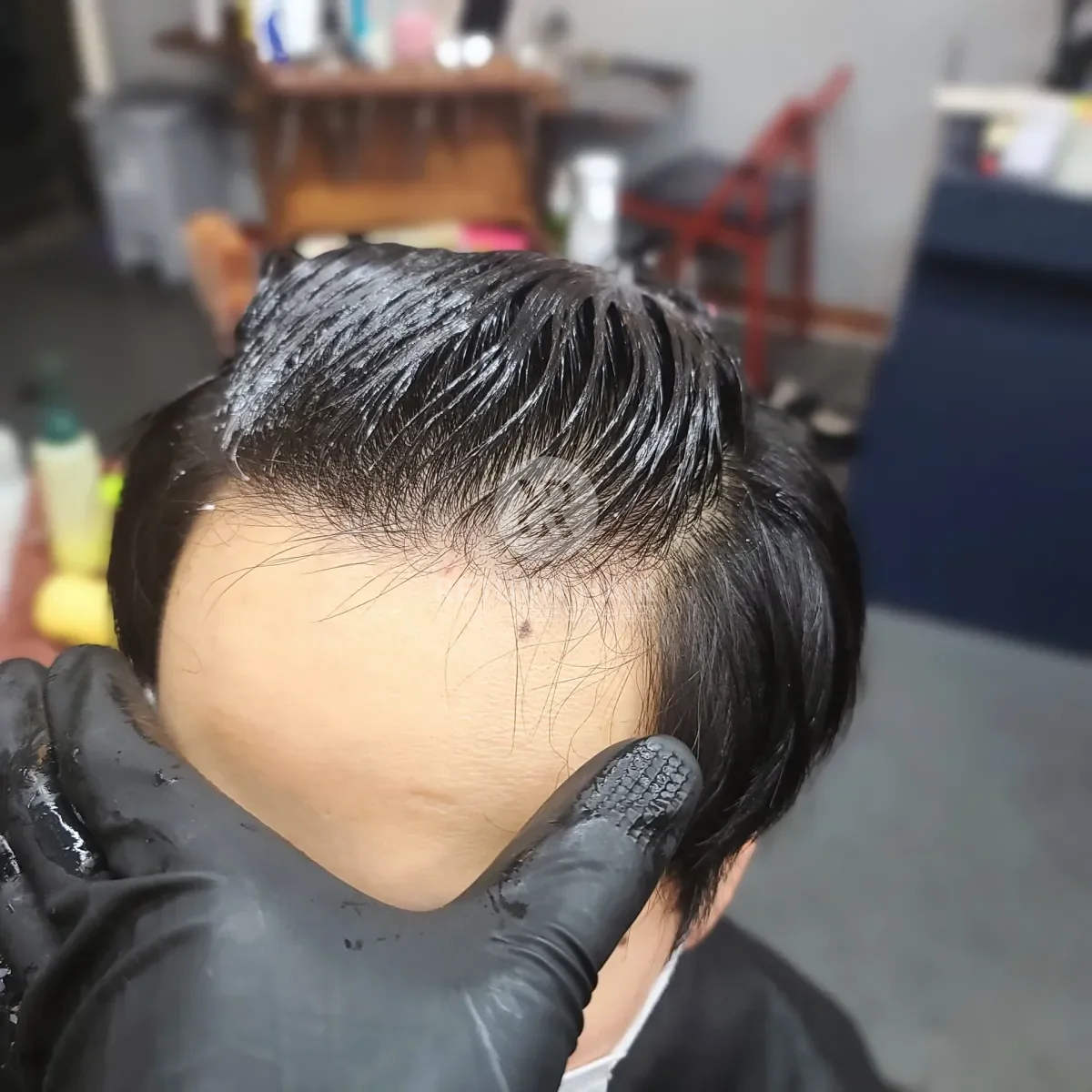 탈모 치트펌 파마 시술 전 사진