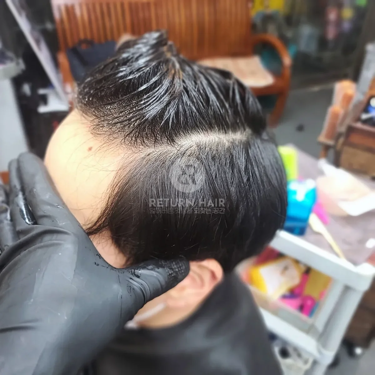탈모 치트펌 파마 시술 전 사진 2