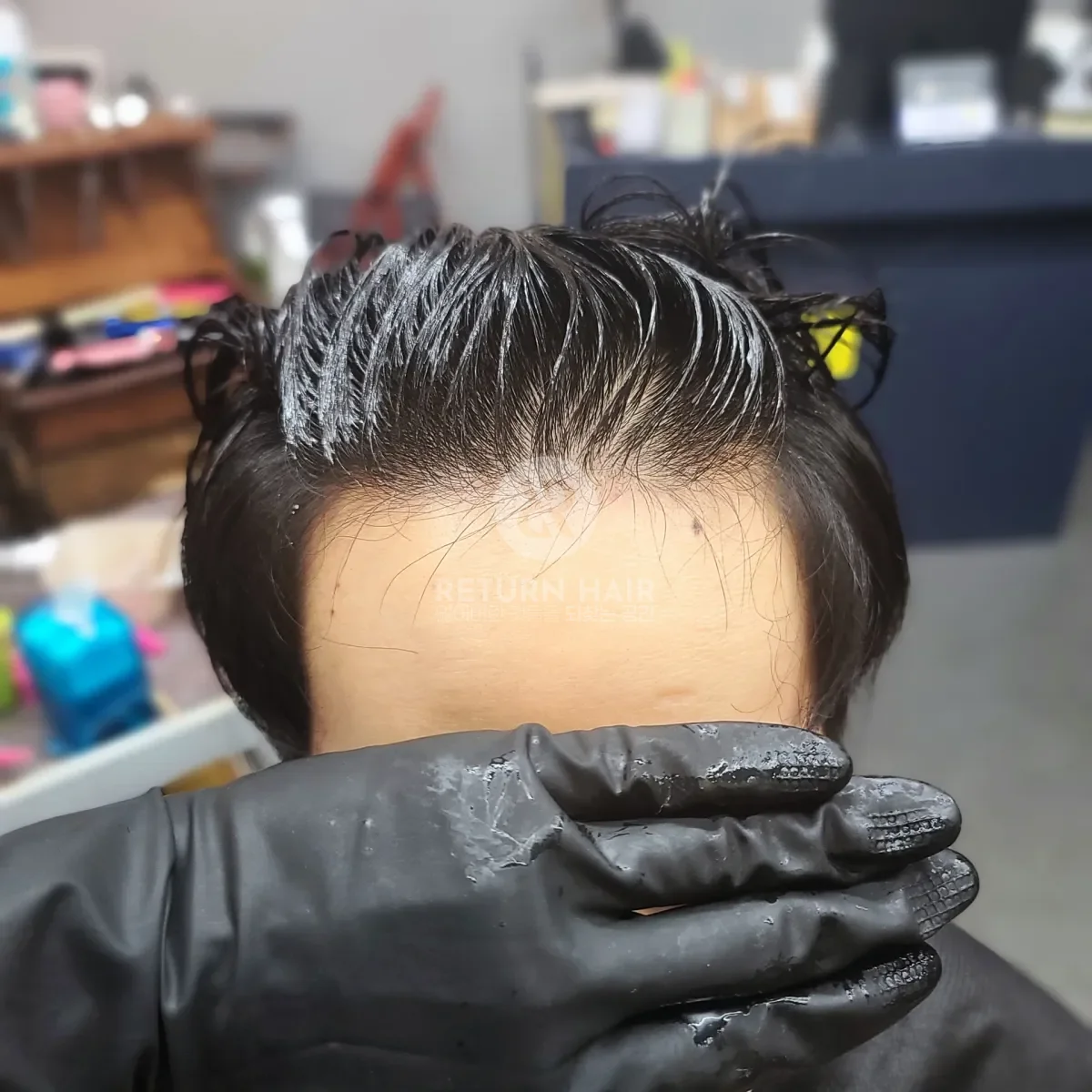 탈모 치트펌 파마 시술 전 사진 4