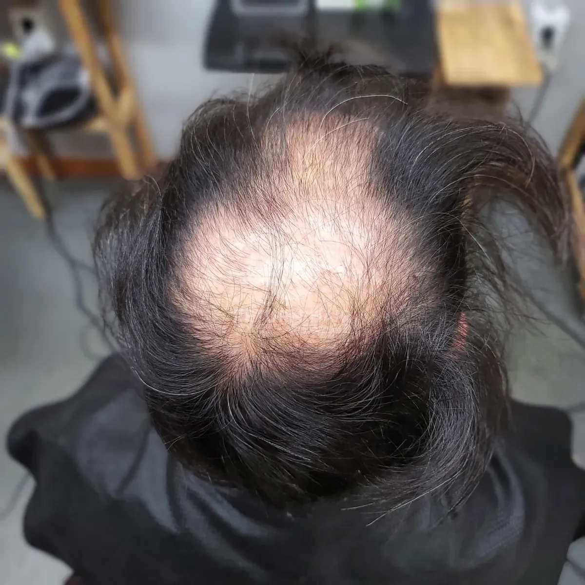 탈모 치트펌 파마 시술 전 사진 2