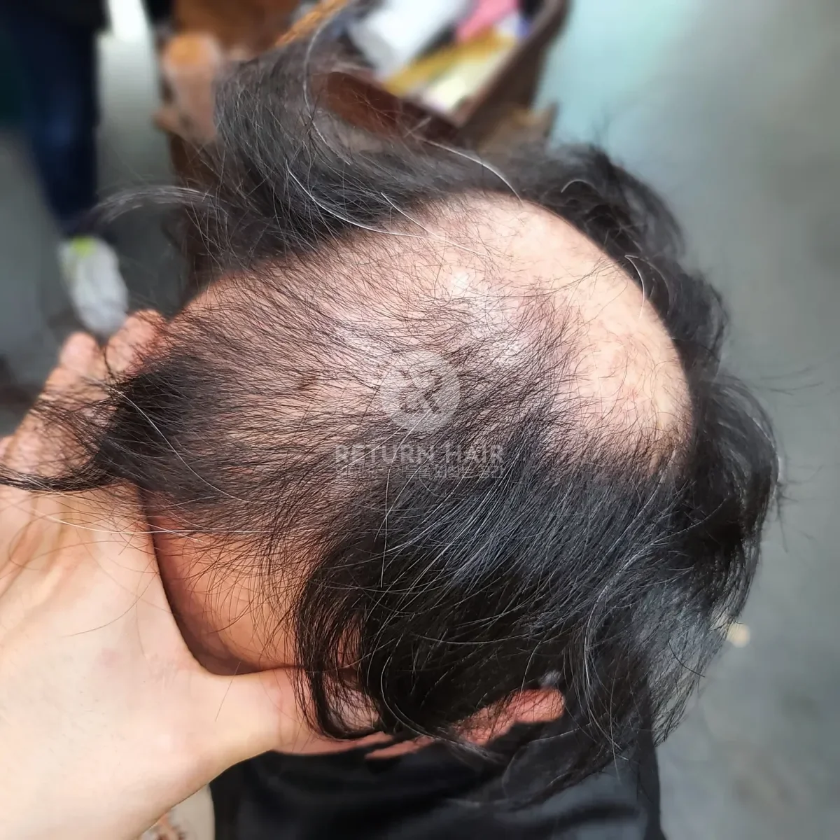 탈모 치트펌 파마 시술 전 사진 3