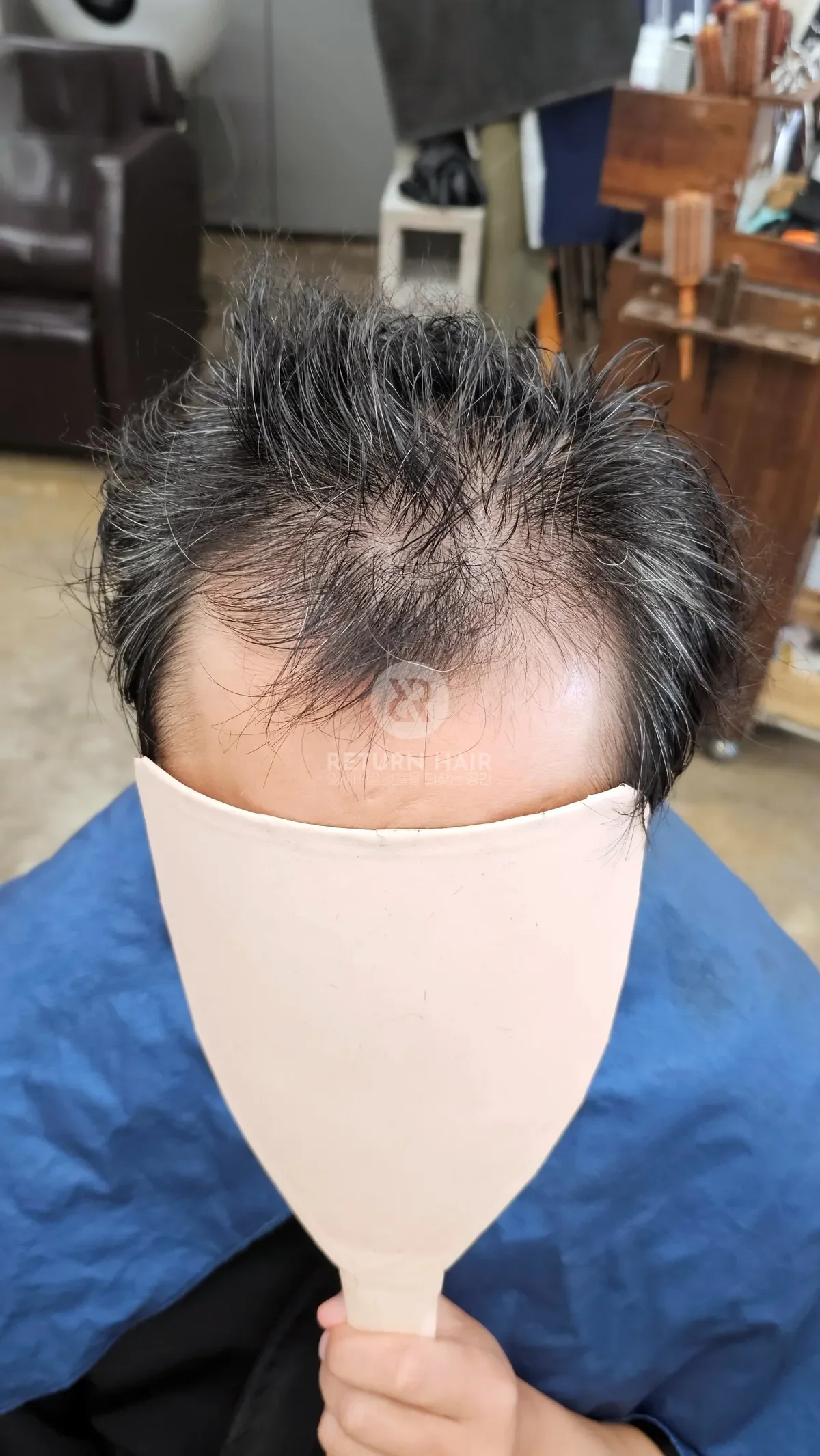 탈모 치트펌 파마 시술 전 사진