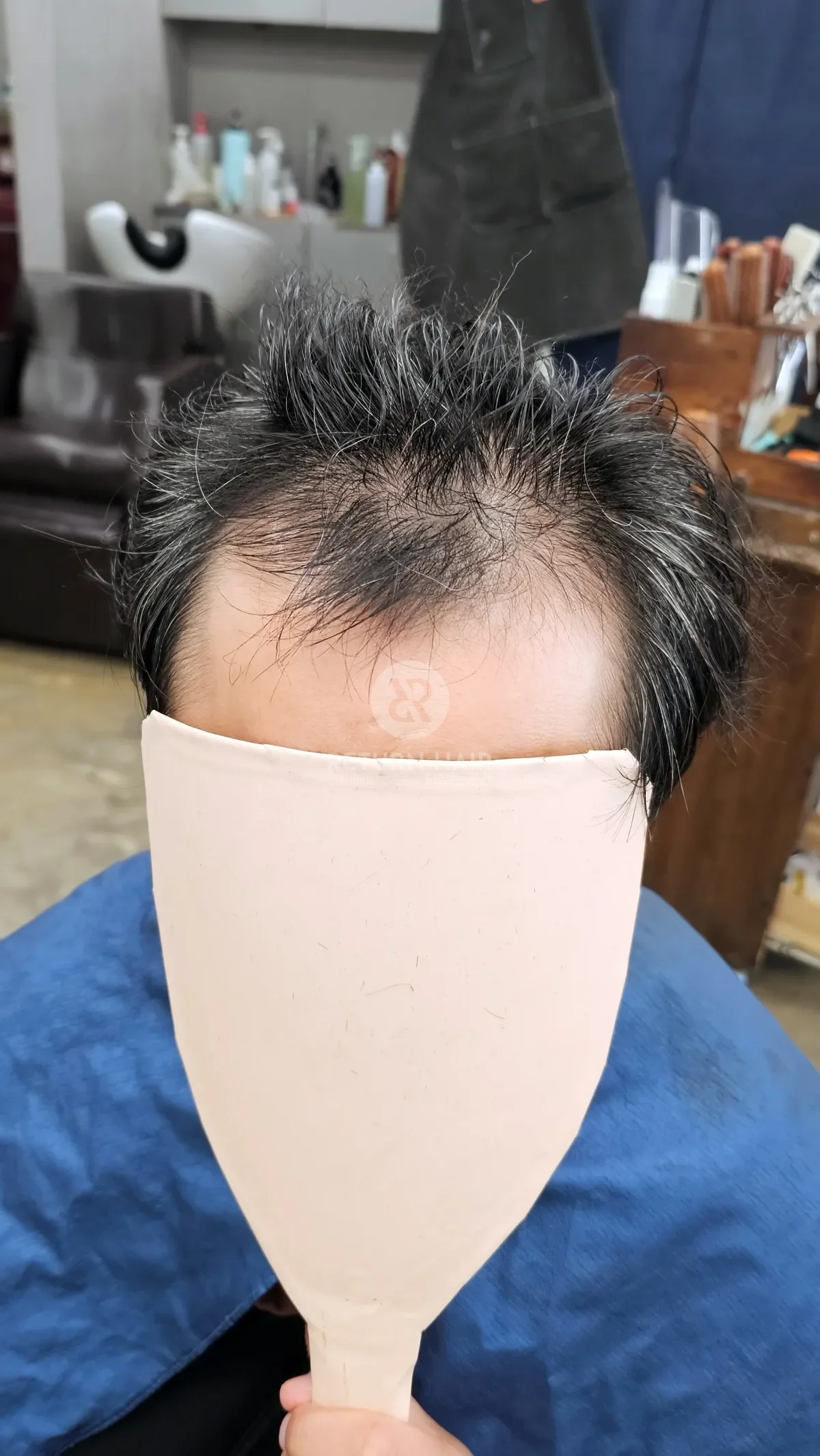 탈모 치트펌 파마 시술 전 사진 2