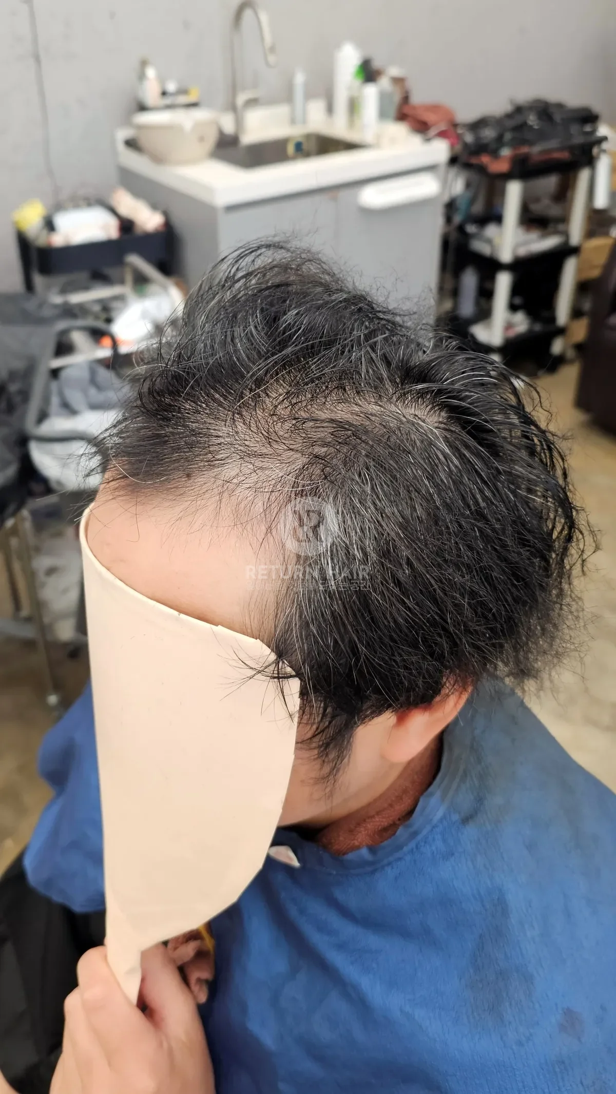 탈모 치트펌 파마 시술 전 사진 3