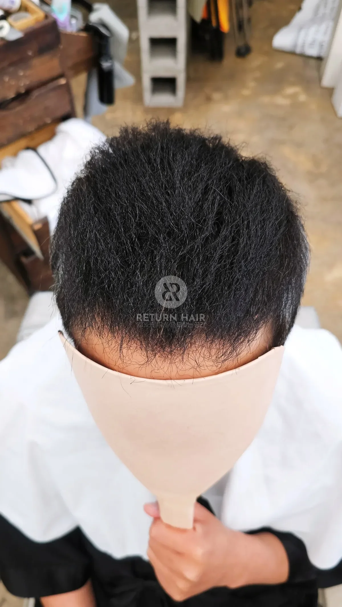 탈모 치트펌 파마 시술 후 결과 사진 2
