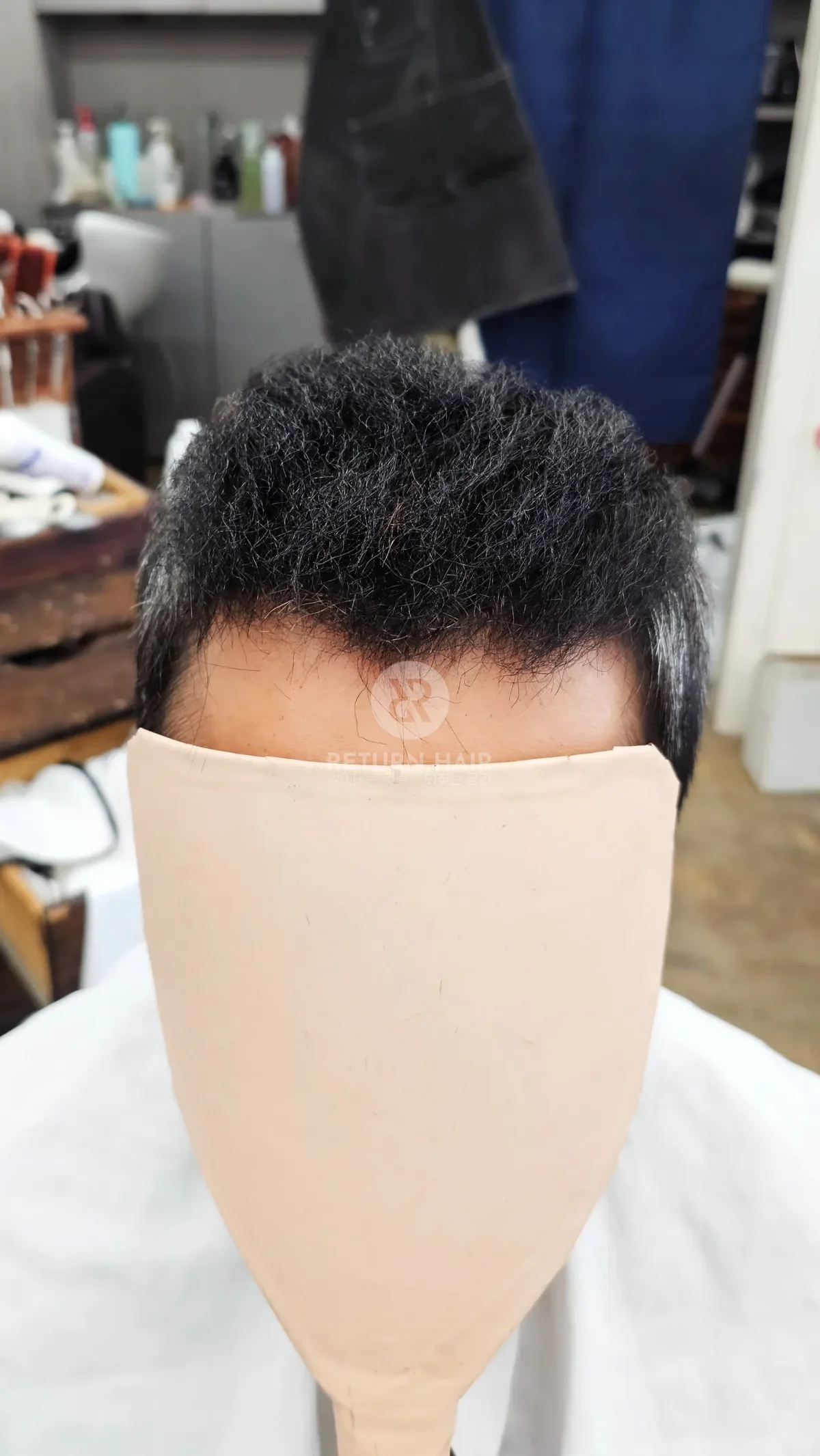 탈모 치트펌 파마 시술 후 결과 사진 3