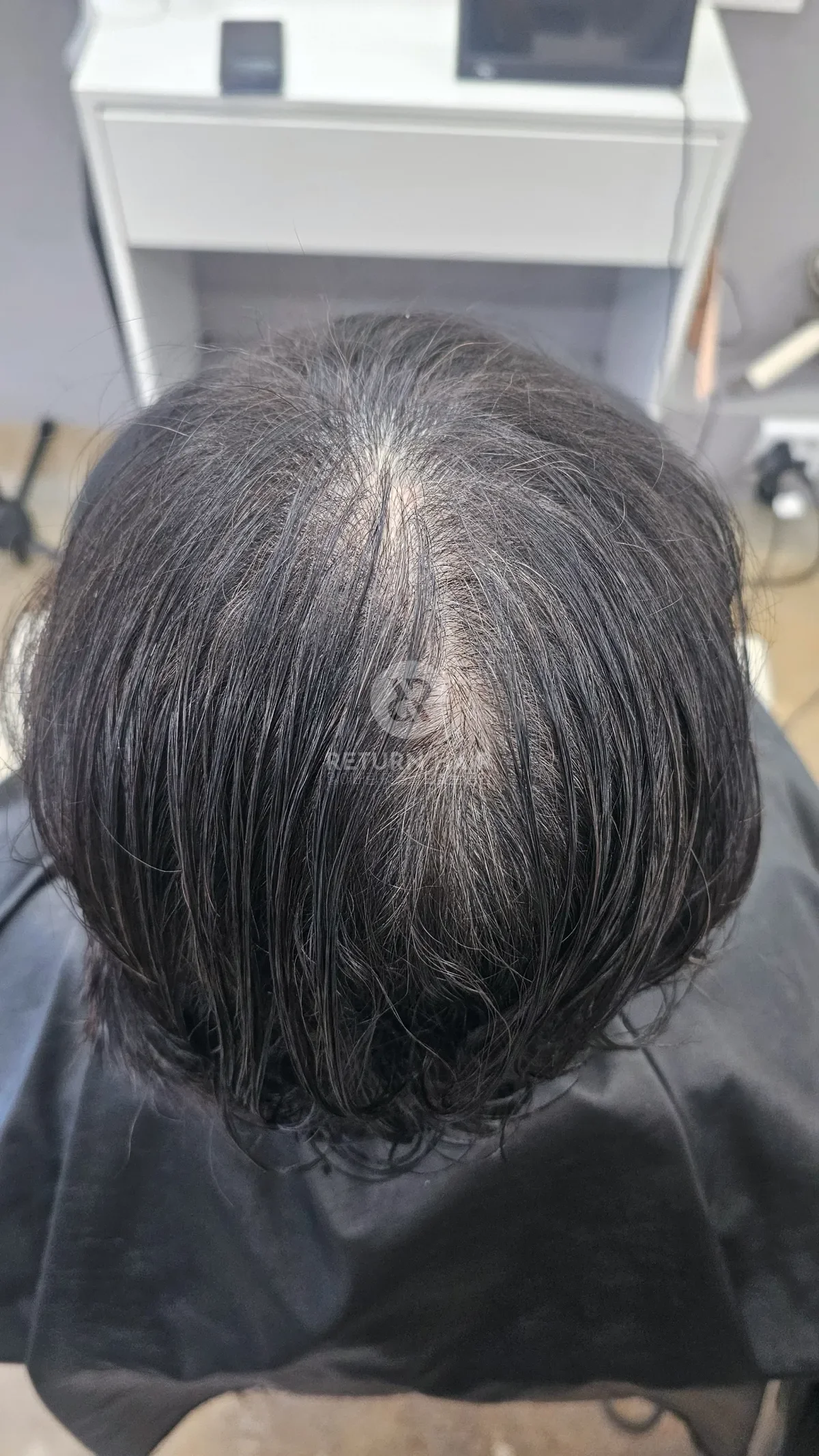 회춘펌 (뿌리볼륨 교정펌) 시술 전 사진