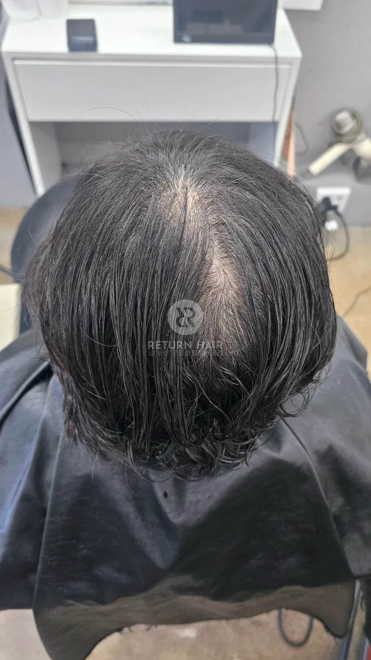 회춘펌 (뿌리볼륨 교정펌) 시술 전 사진 2