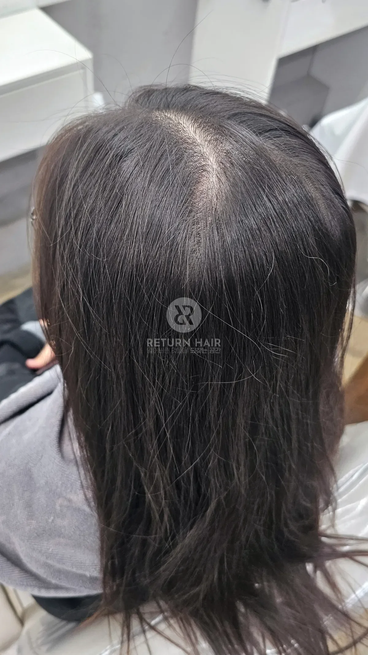 회춘펌 (뿌리볼륨 교정펌) 시술 전 사진 2