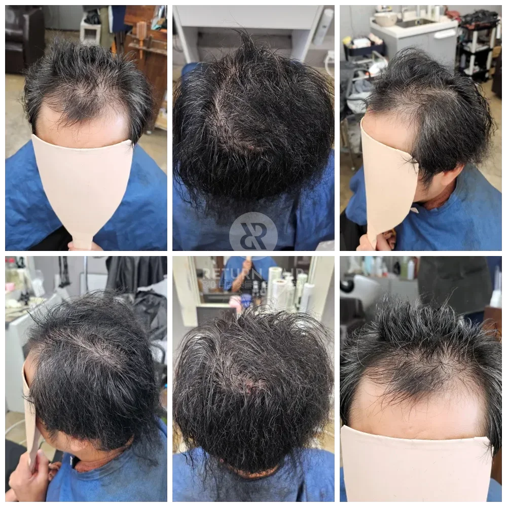 탈모 치트펌 파마 시술 전 사진