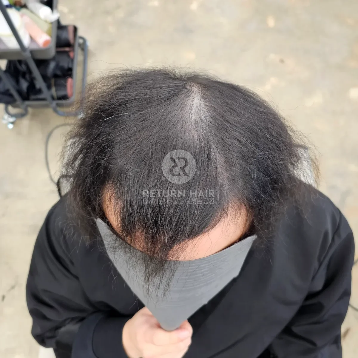 탈모 치트펌 파마 시술 전 사진