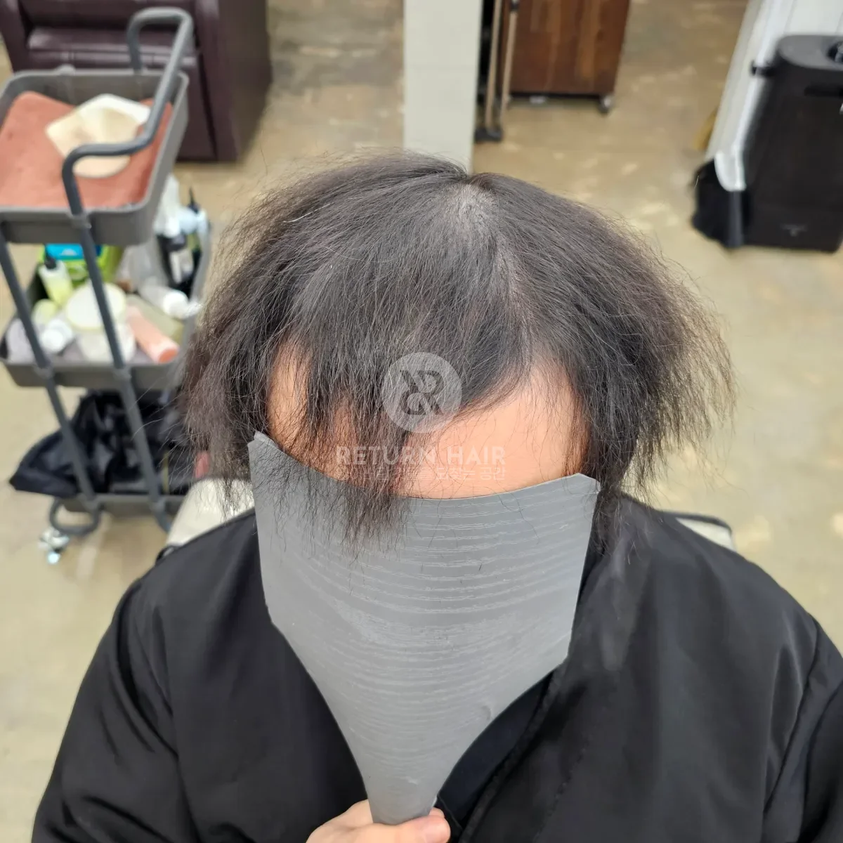 탈모 치트펌 파마 시술 전 사진 2