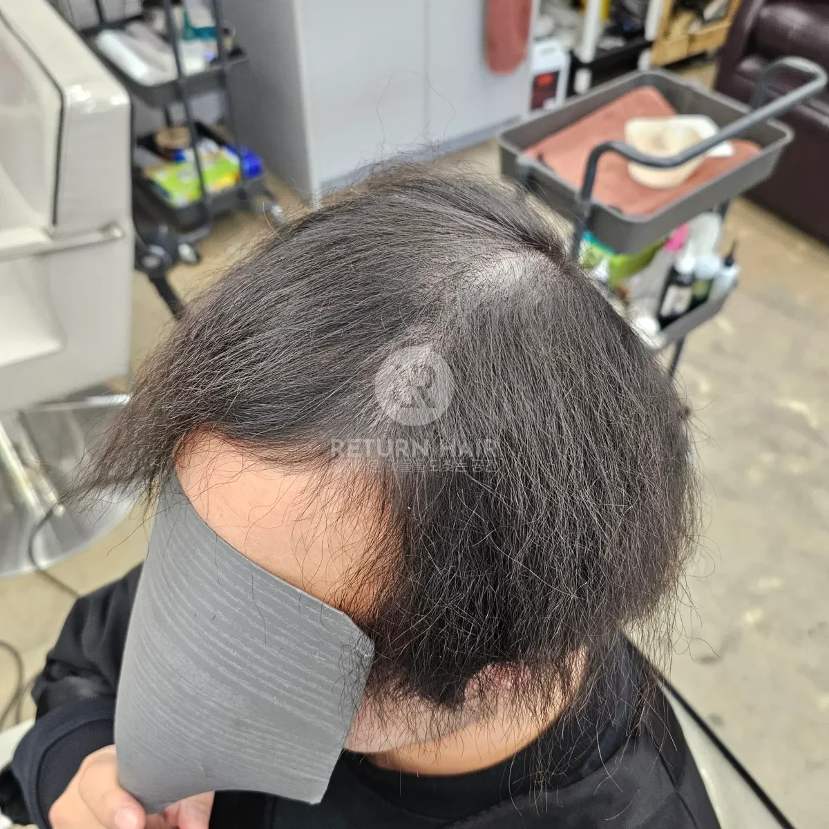 탈모 치트펌 파마 시술 전 사진 3