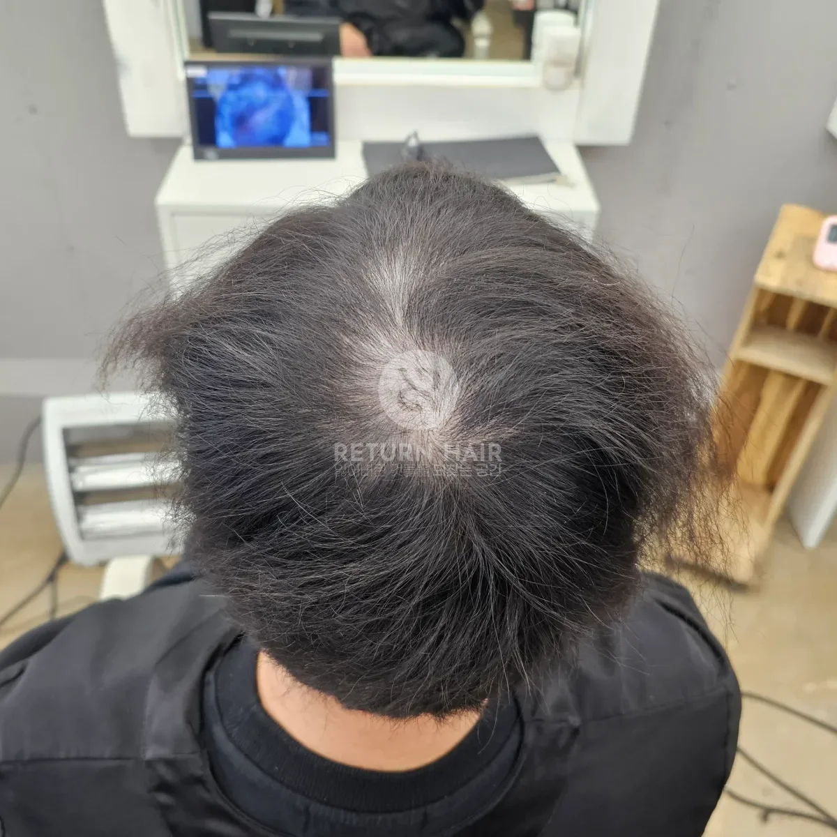 탈모 치트펌 파마 시술 전 사진 5