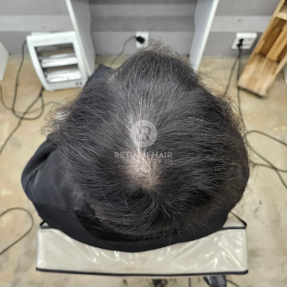 탈모 치트펌 파마 시술 전 사진 6