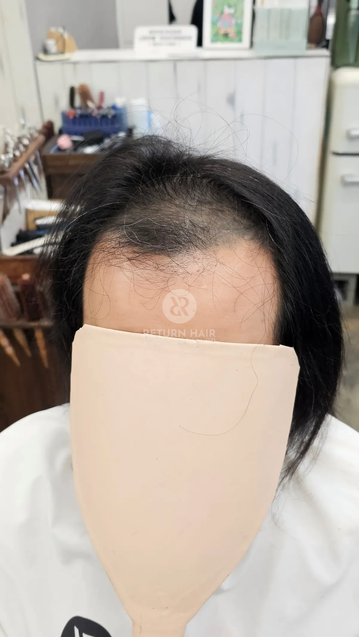 탈모 치트펌 파마 시술 전 사진