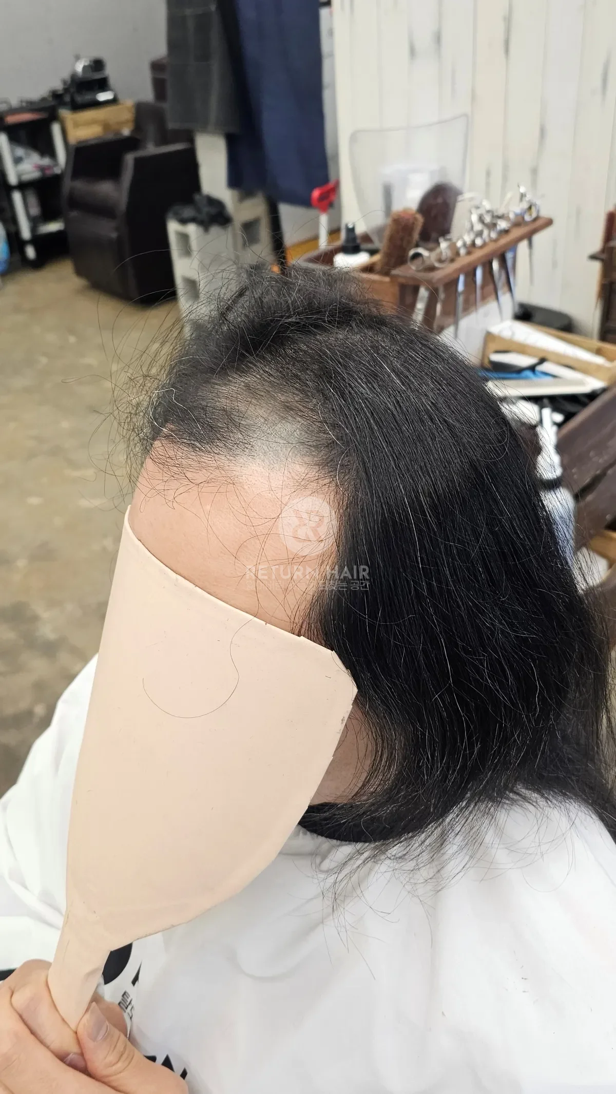 탈모 치트펌 파마 시술 전 사진 2