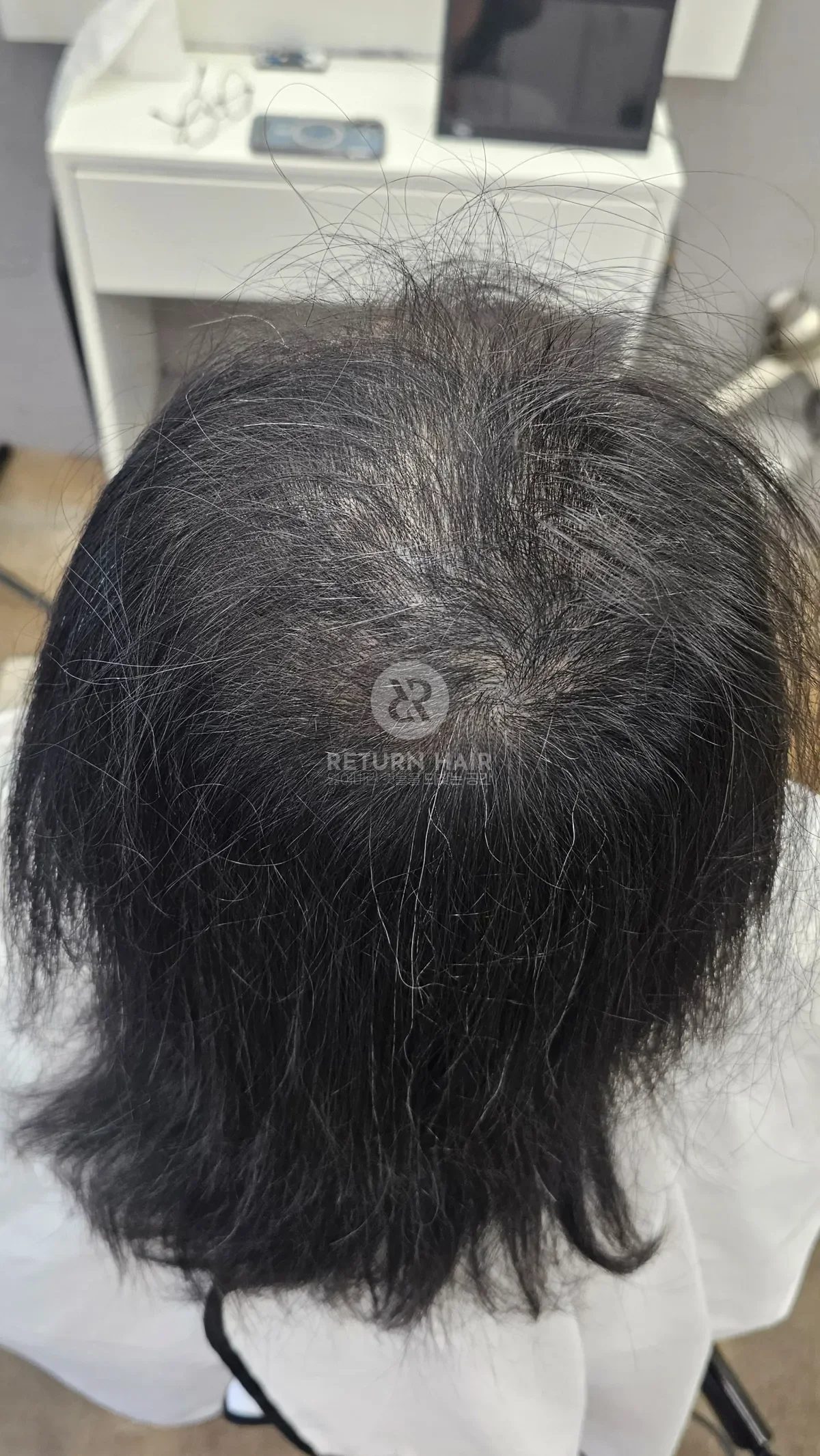 탈모 치트펌 파마 시술 전 사진 5