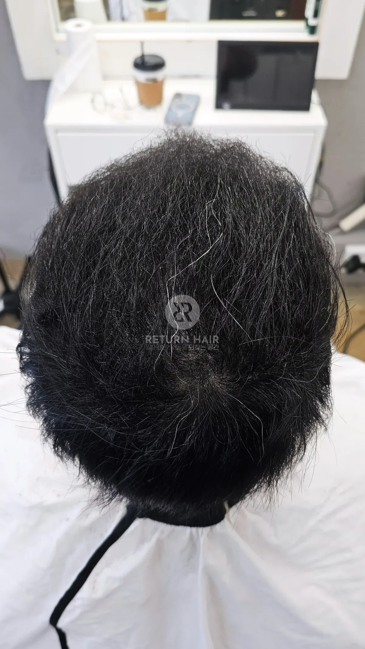 탈모 치트펌 파마 시술 후 결과 사진 5