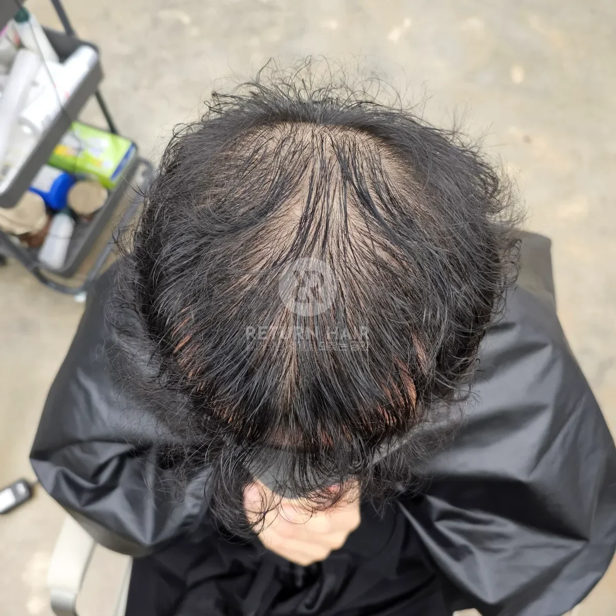 두피페인팅 (치트염색) 시술 전 사진