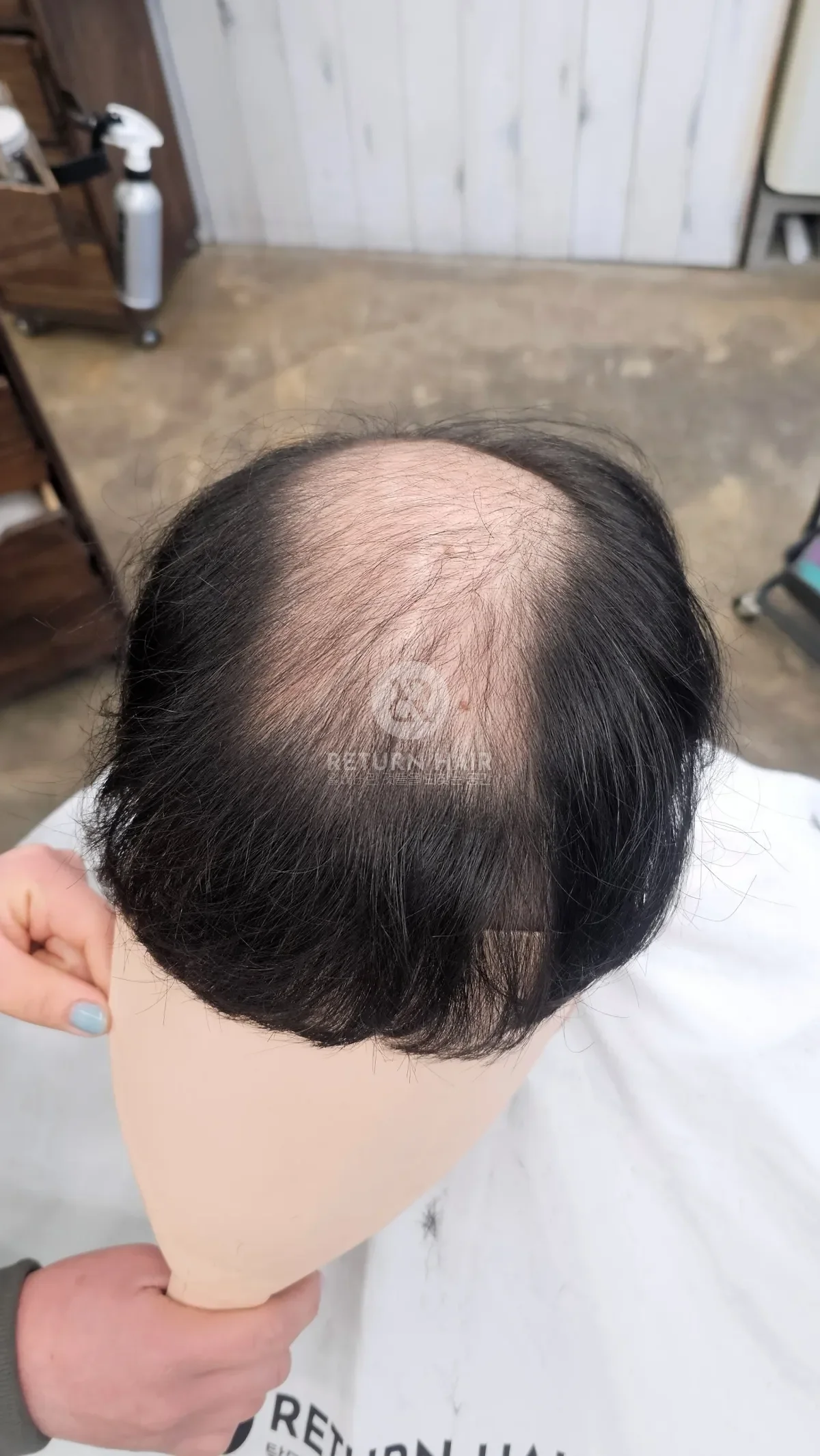 탈모 치트펌 파마 시술 전 사진