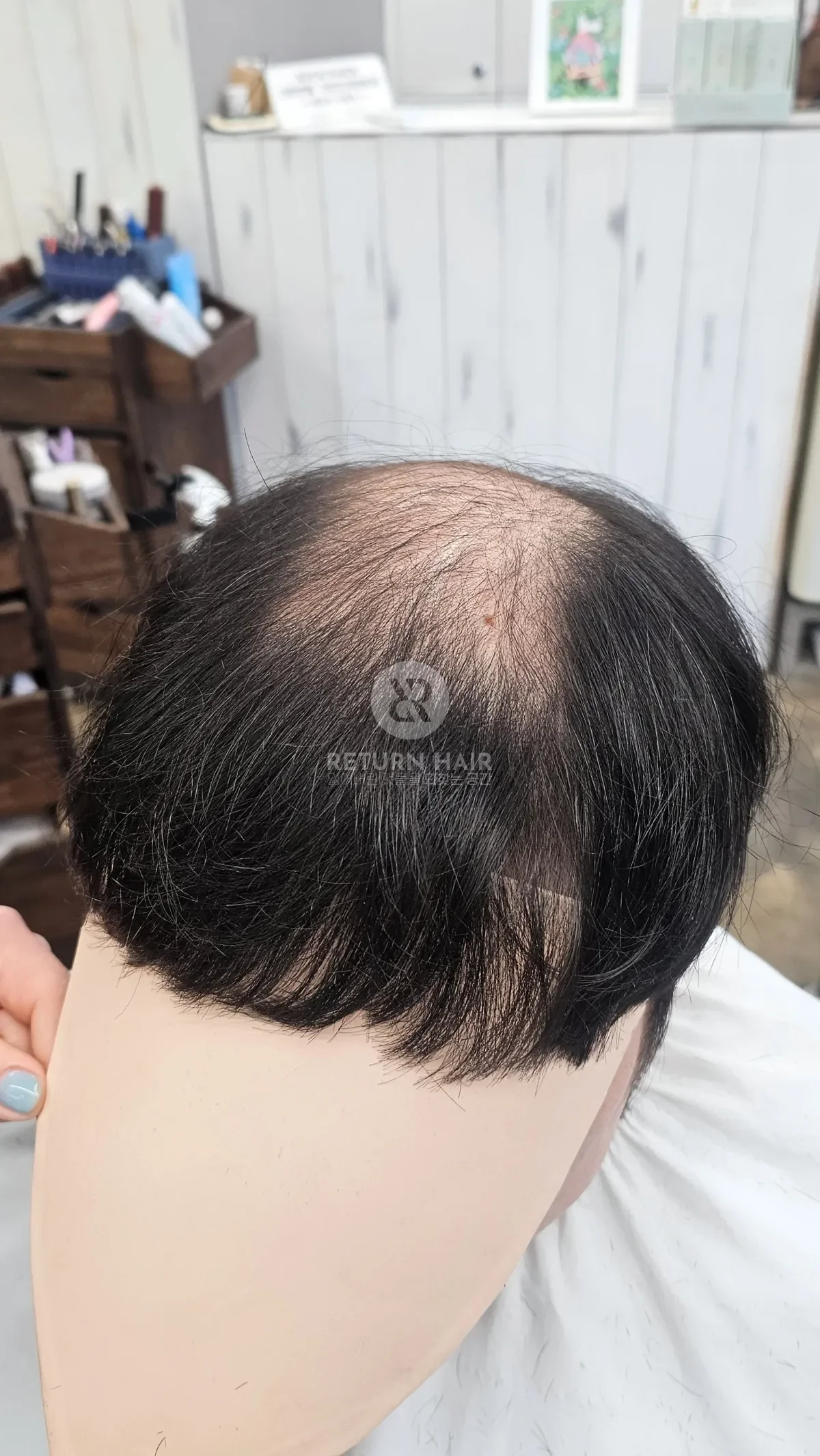 탈모 치트펌 파마 시술 전 사진 2